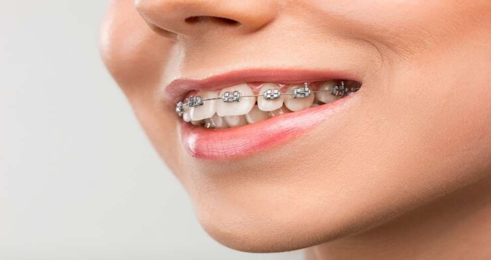 Braces Supported by Dental Group Expertise